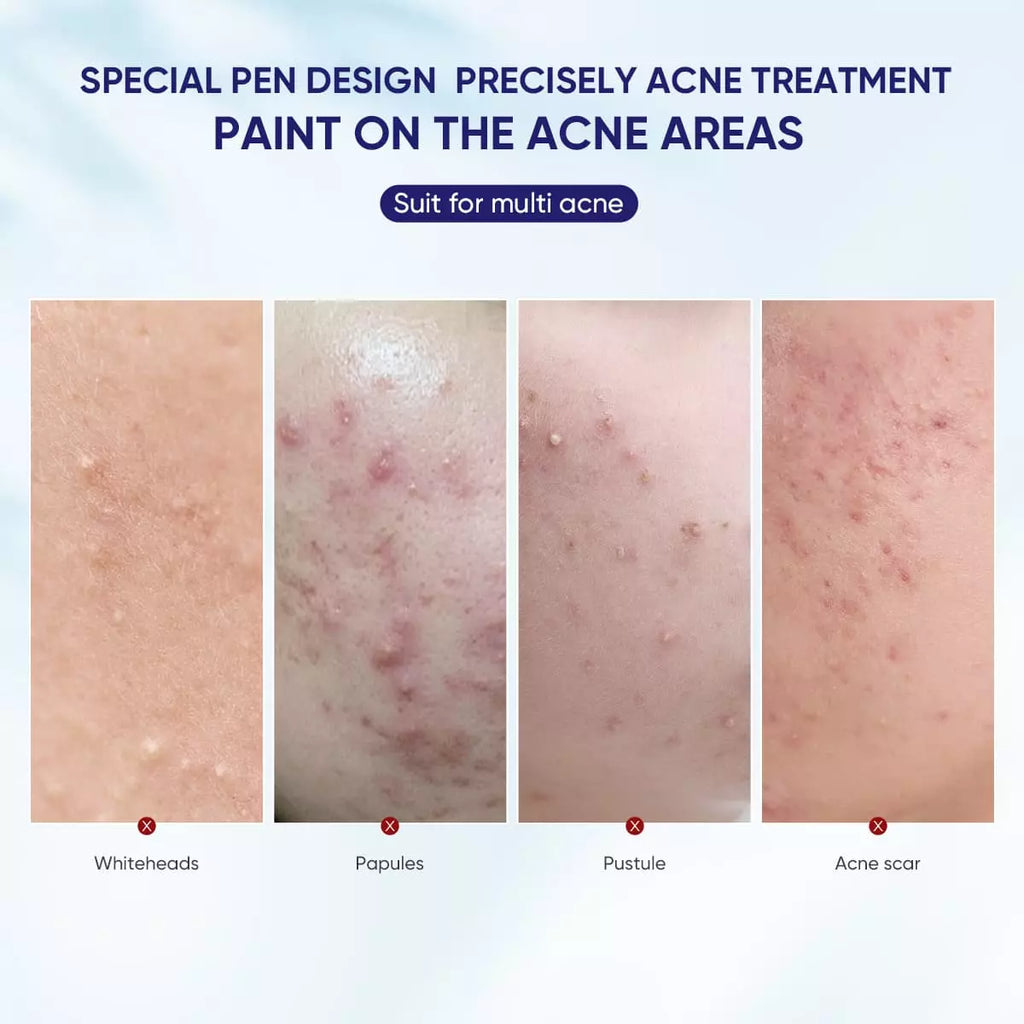 Acne Spot Saviour