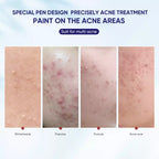 Acne Spot Saviour