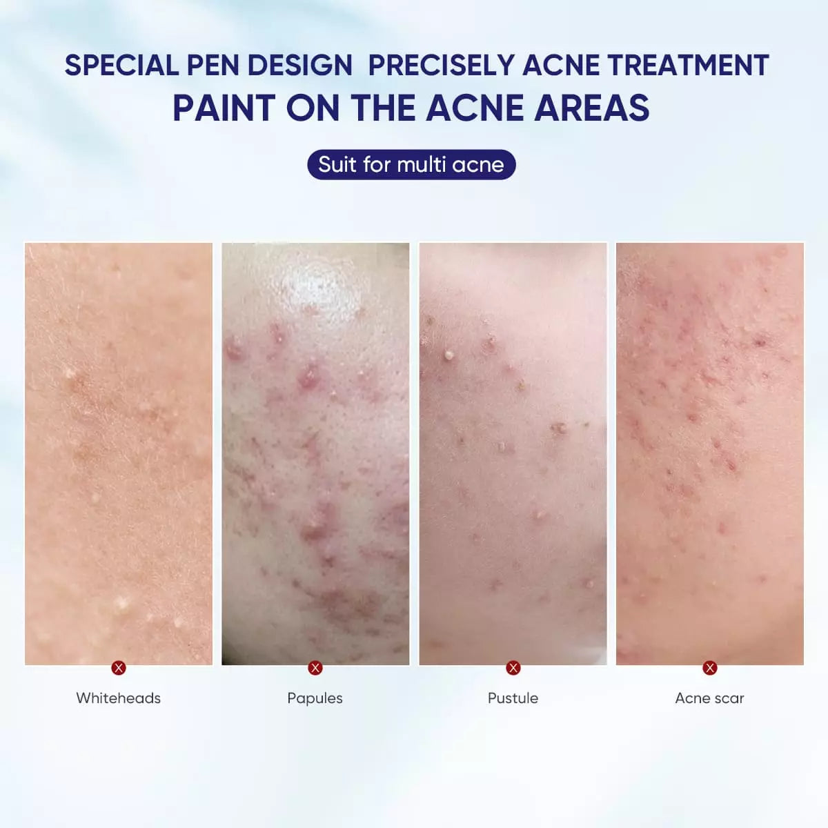 Acne Spot Saviour